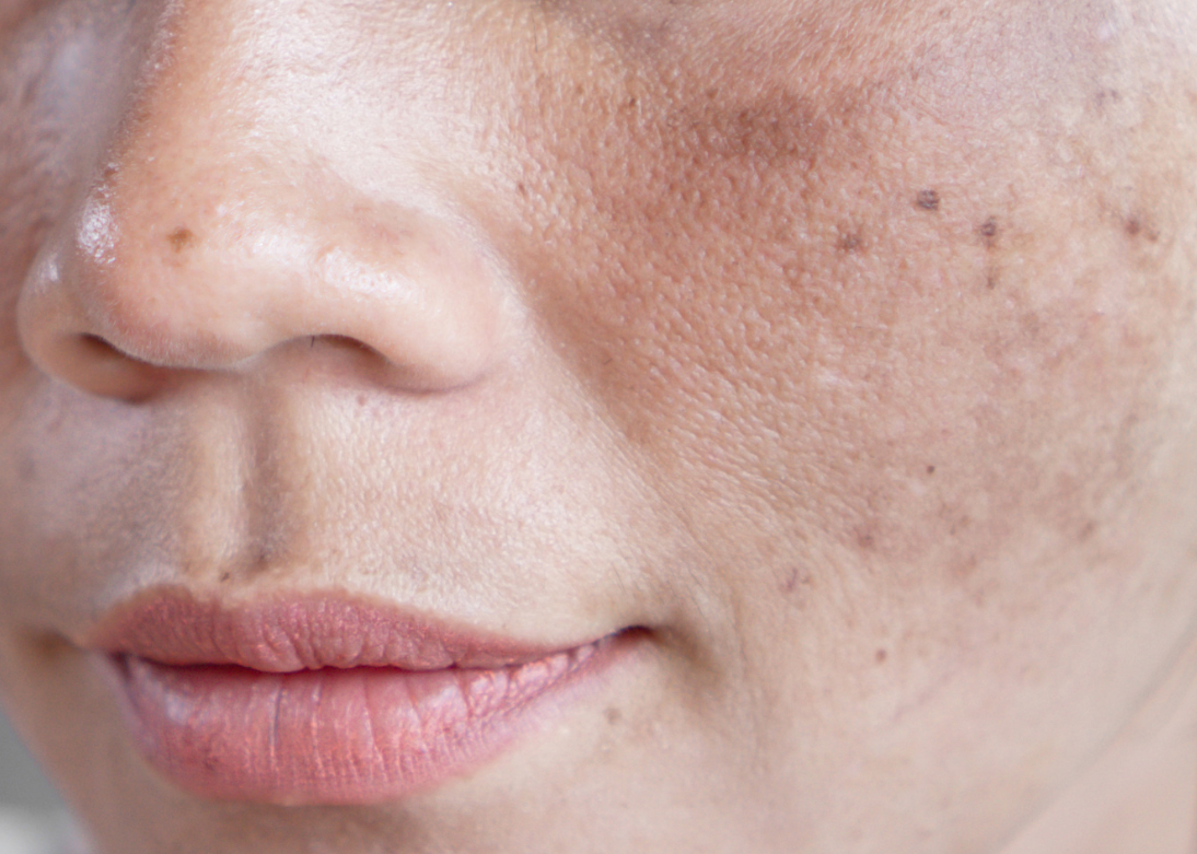 Freckles on Face